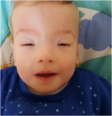 Case Report: Blepharophimosis and Ptosis as Leading Dysmorphic Features of Rare Congenital Malformation Syndrome With Developmental Delay – New Cases With TRAF7 Variants